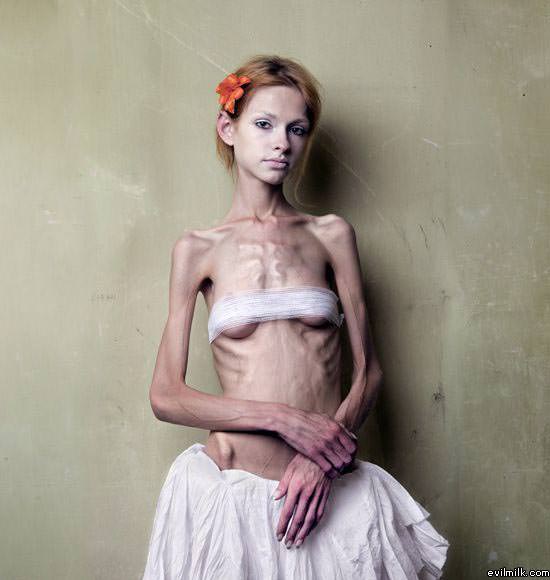 Anorexic Model