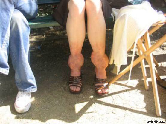 Swollen Ankles