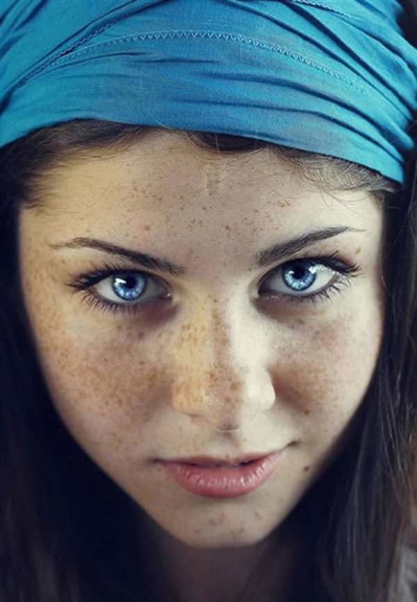 freckles