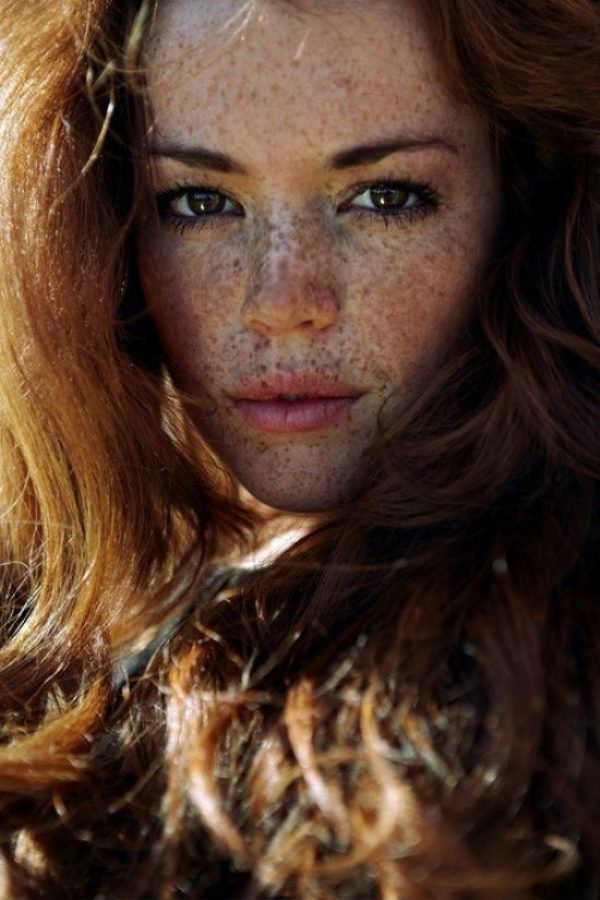 freckles