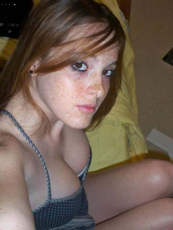 freckles