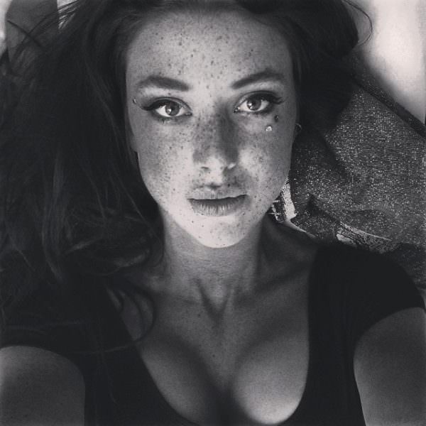 freckles