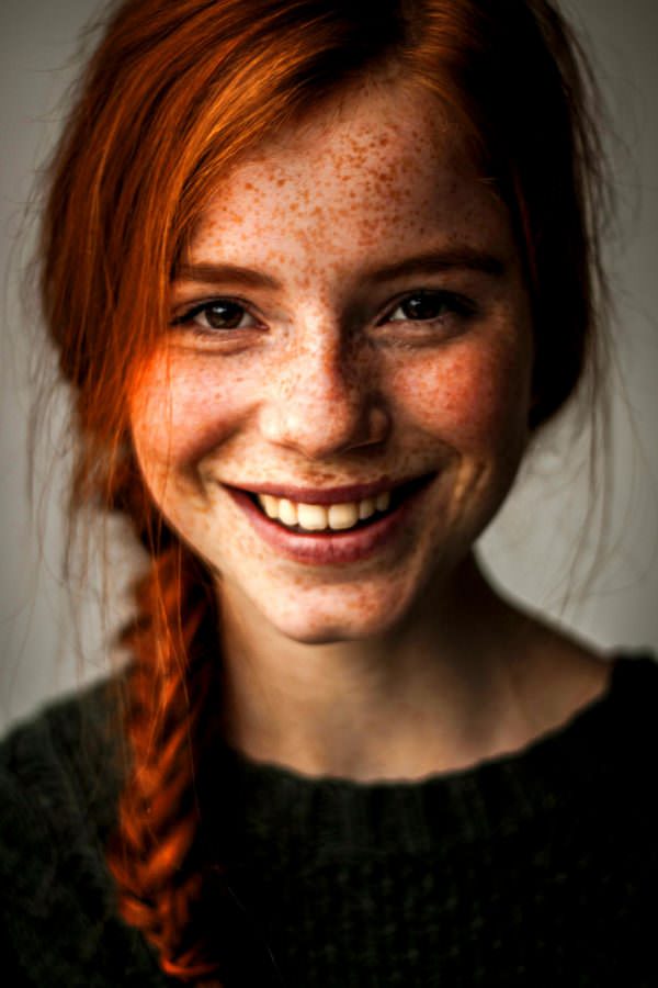 freckles