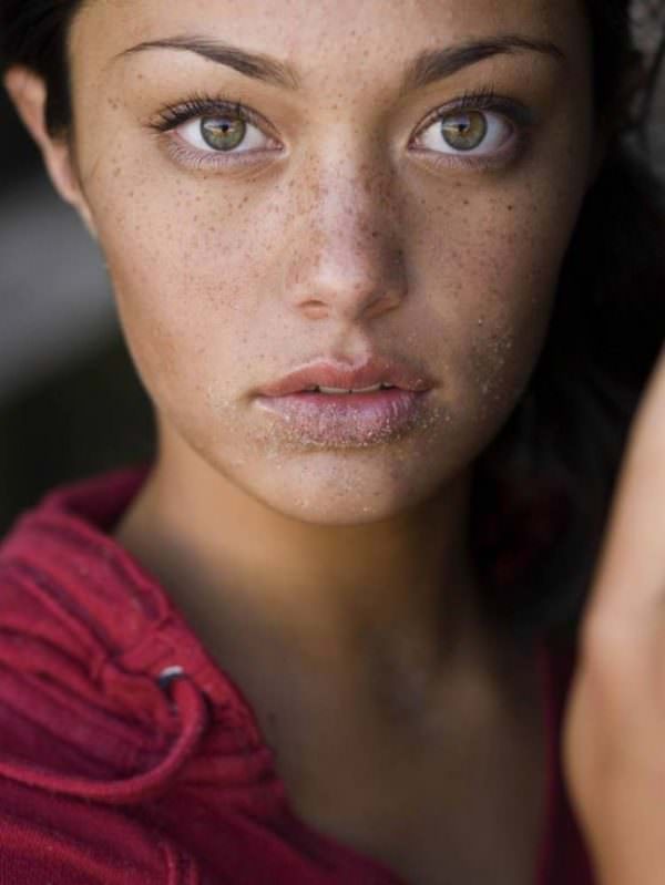 freckles