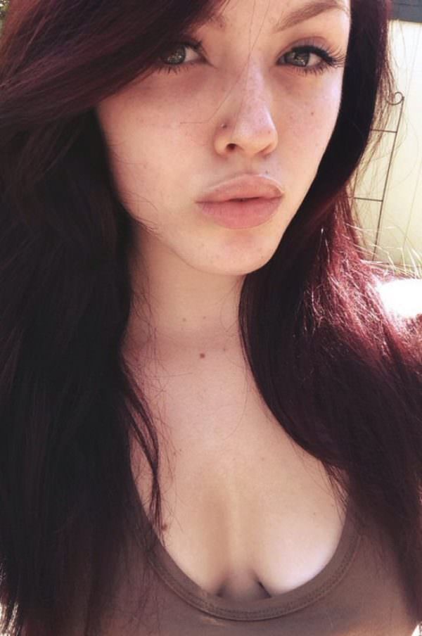 freckles