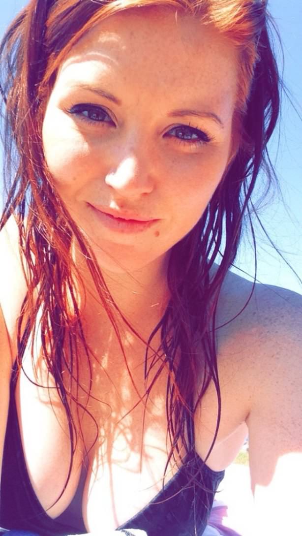 freckles