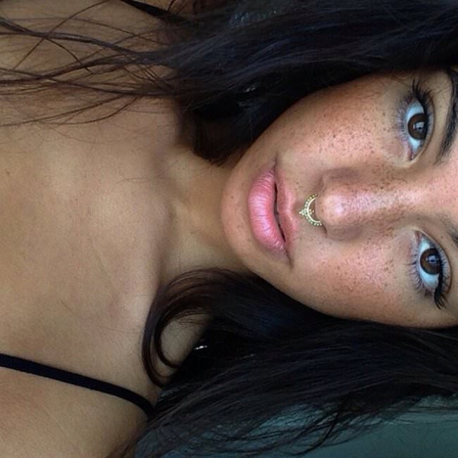 freckles