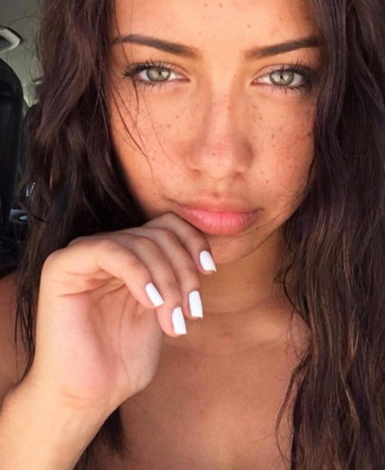 freckles