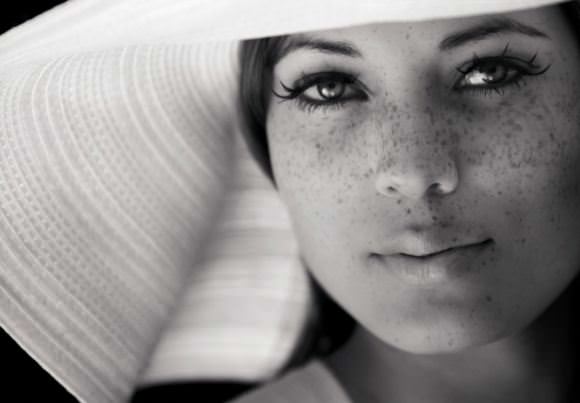 freckles