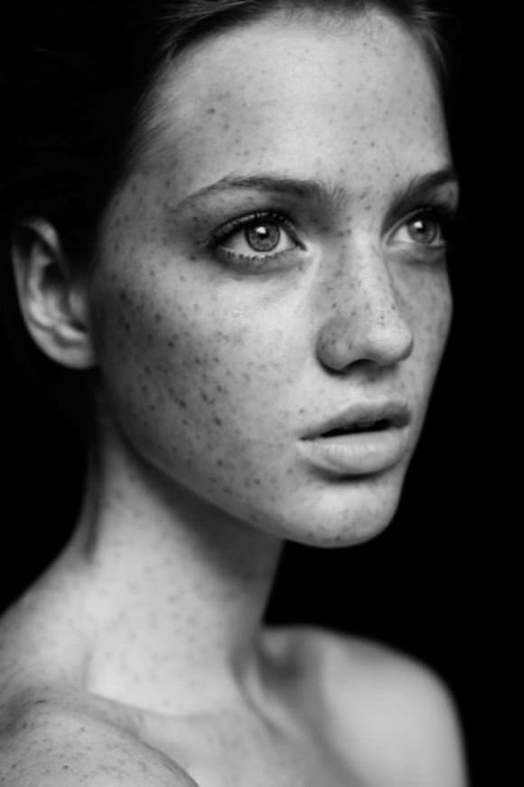 freckles