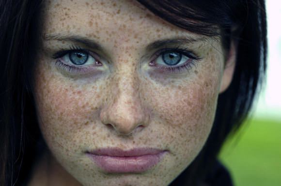 freckles