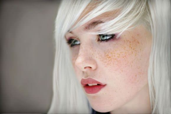 freckles