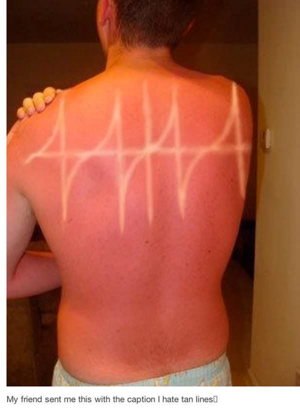 sun burns.
