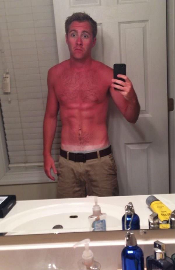 sunburns