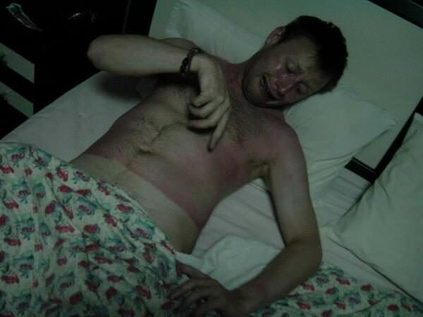 sunburns