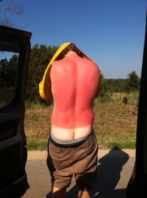 sunburns