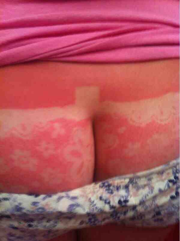 sunburns