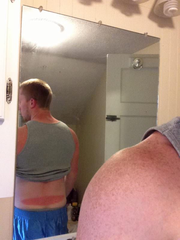 sunburns