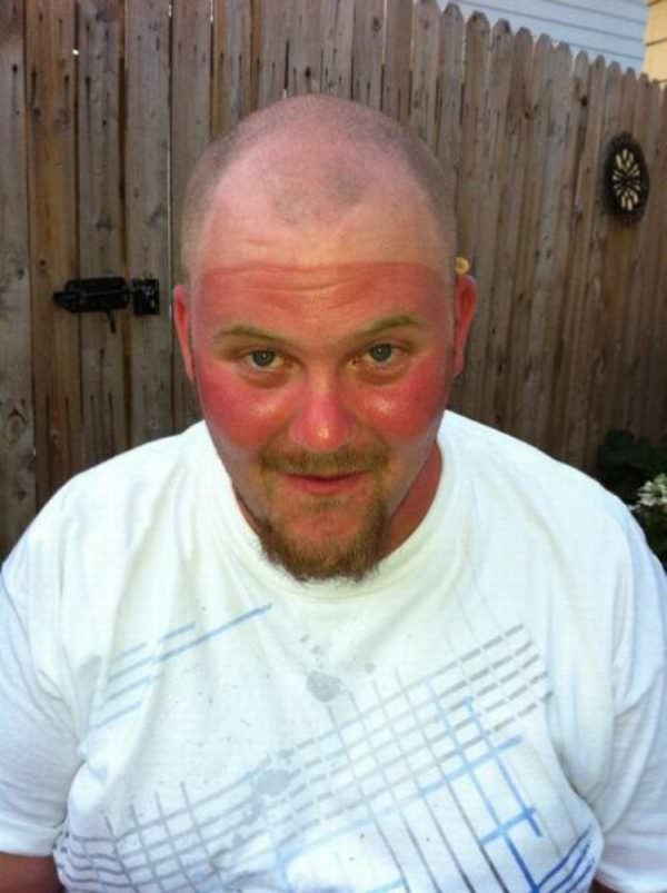 sunburns