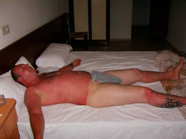 sunburns