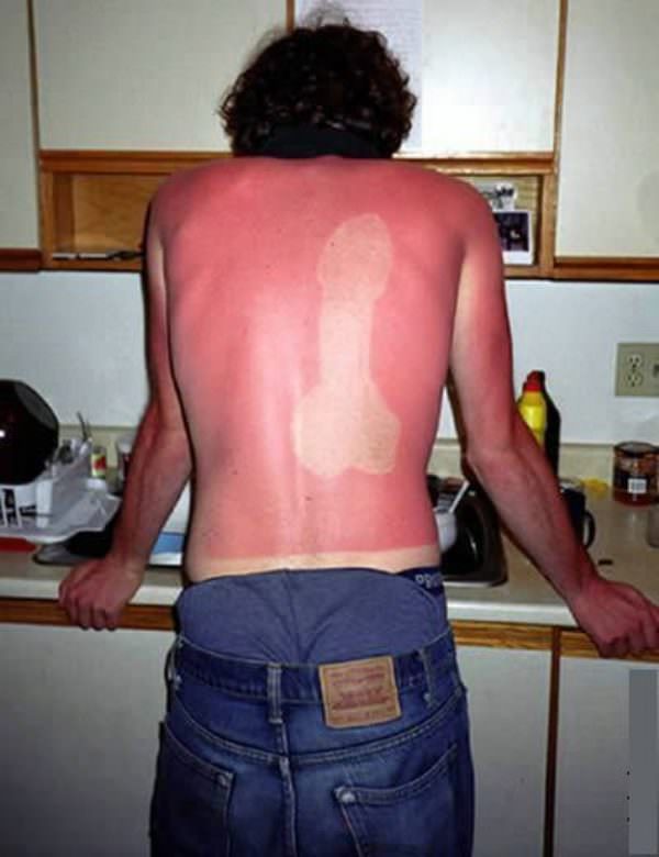 sunburns