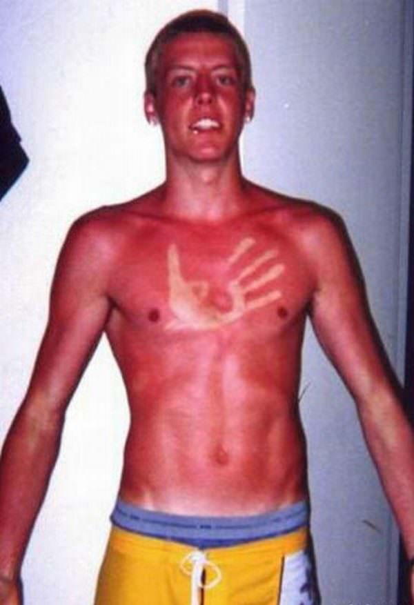 sunburns.