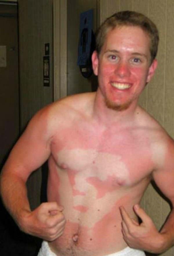 sunburns