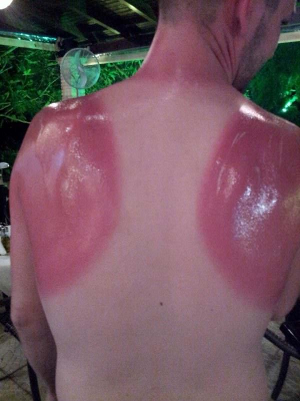 sunburns