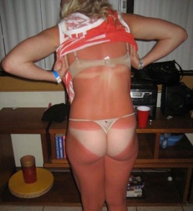 sunburn