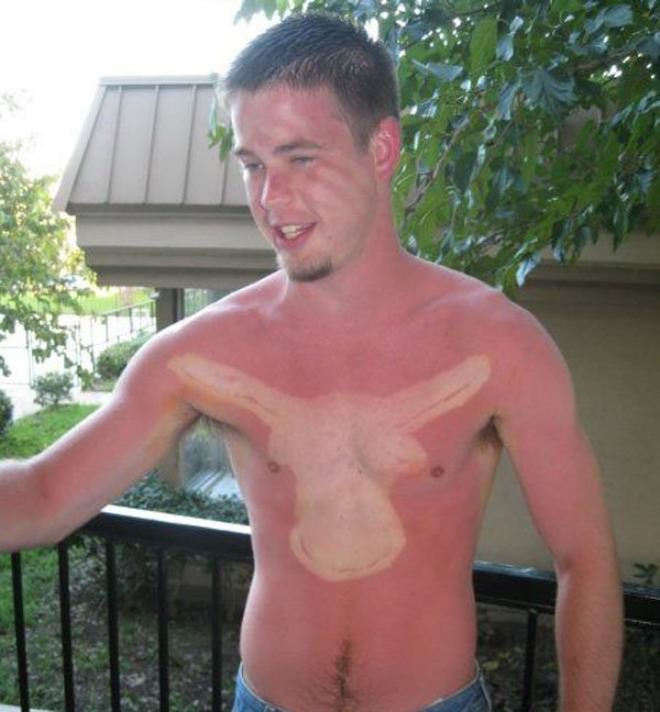 sunburn