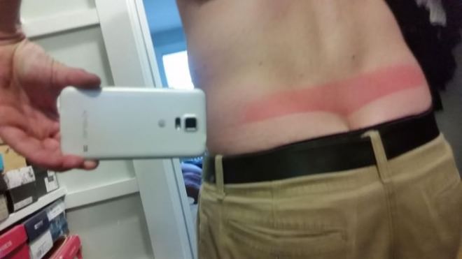 sun burn