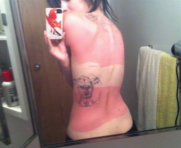 Amazing Sunburns Picdump