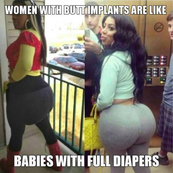 Butt Implants