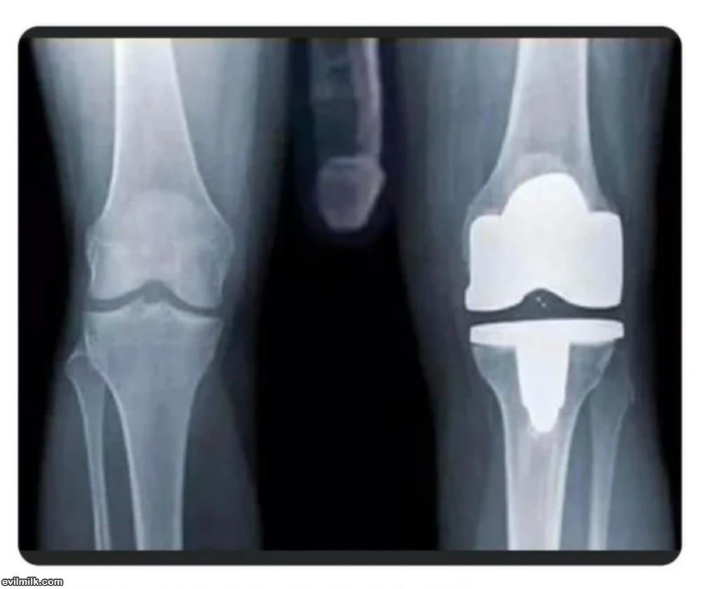 Knee Replacement Xray