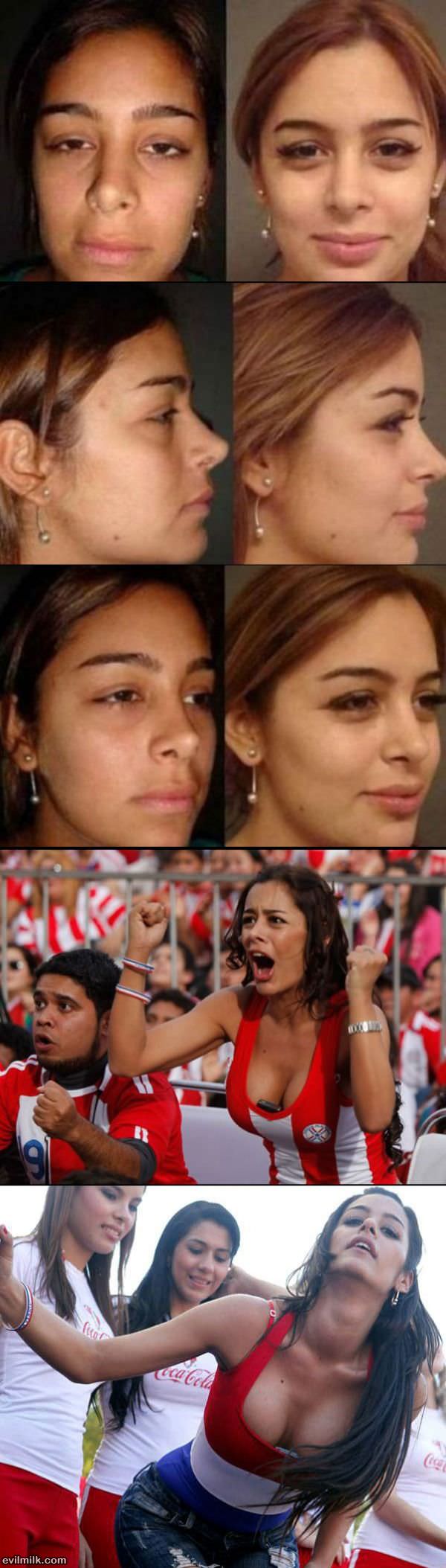 Larissa Riquelme Plastic Surgery