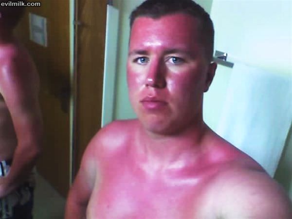 Sunburn