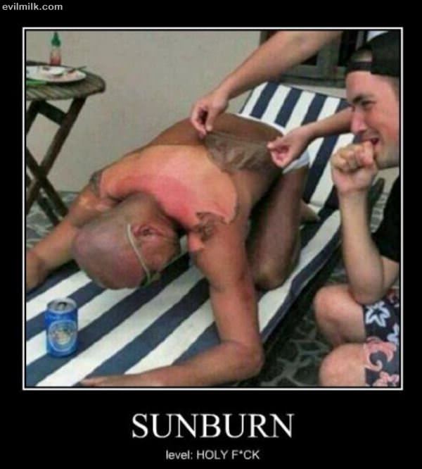 Sunburn