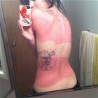 Amazing Sunburns Picdump