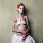 Anorexic Model