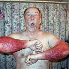 Arm Scraped