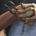 Gross Finger Nails