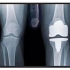 Knee Replacement Xray