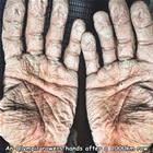 Prune Hands