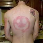 Smiley Sunburn