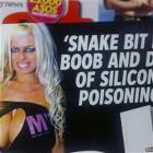 Snake Bit My Boob