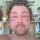 Stung By A Bee