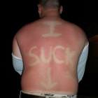 Sucky Sunburn