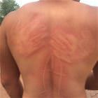 Sun Burns 6