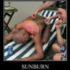 Sunburn