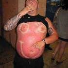 Sunburn Like A Boss